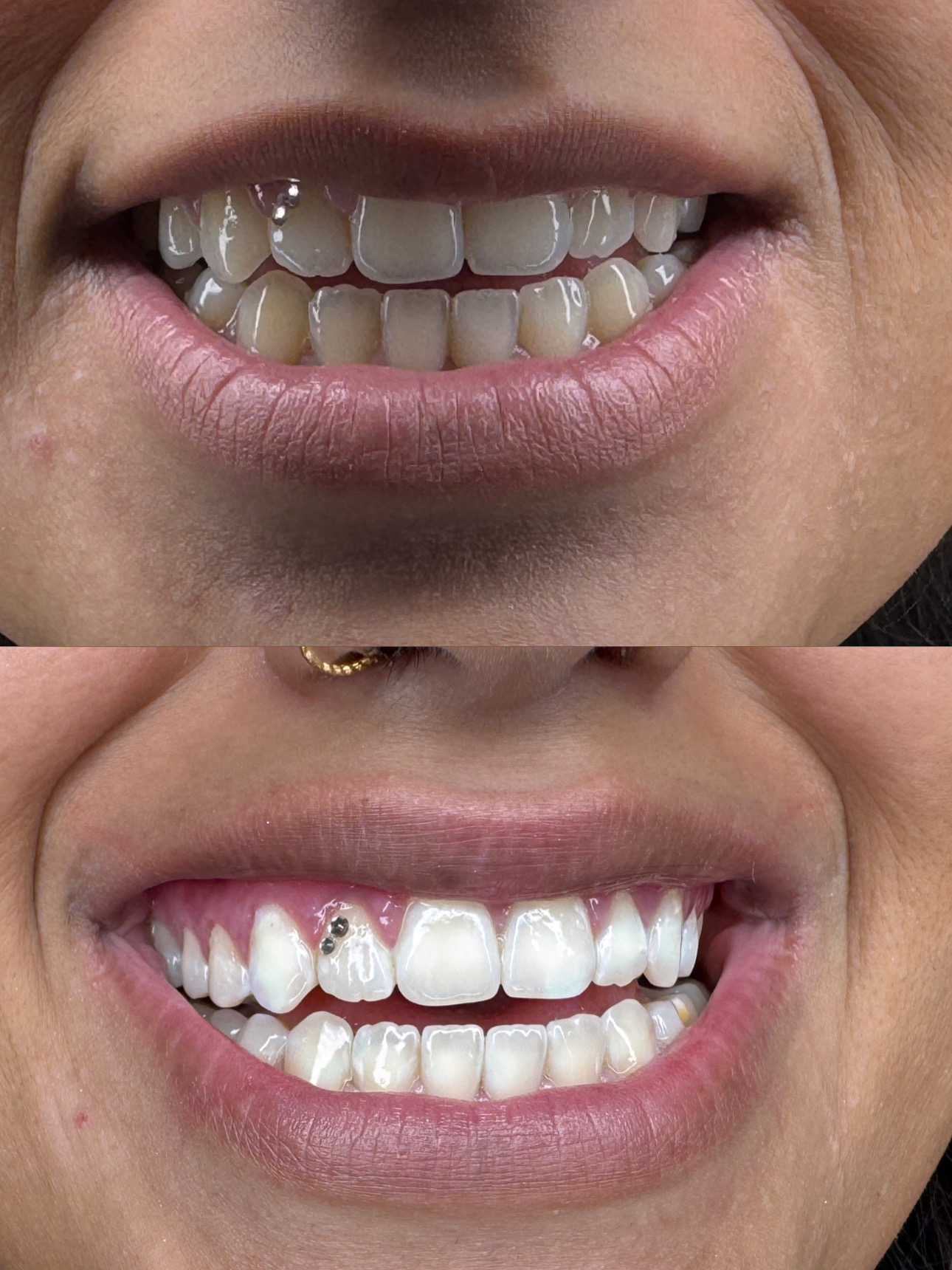 Zahnbleaching Ergebnis